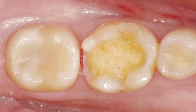 下顎左側第一大臼歯の窩洞形成を行うイメージ