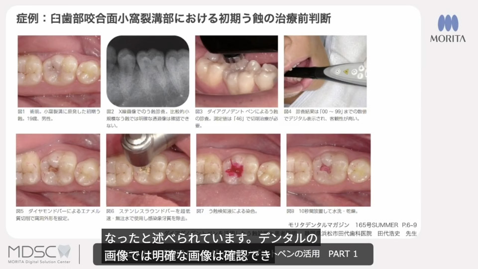 モリタ】ダイアグノデント ペン - 特長｜歯科情報ポータルサイト