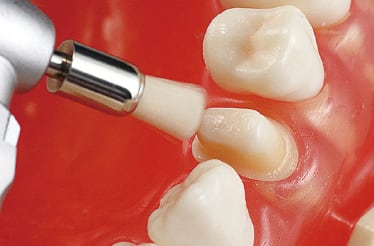 支台歯の前処理 イメージ画像