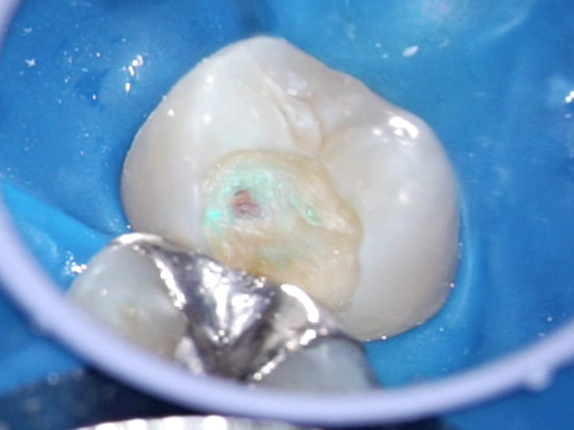 感染歯質除去時に露髄